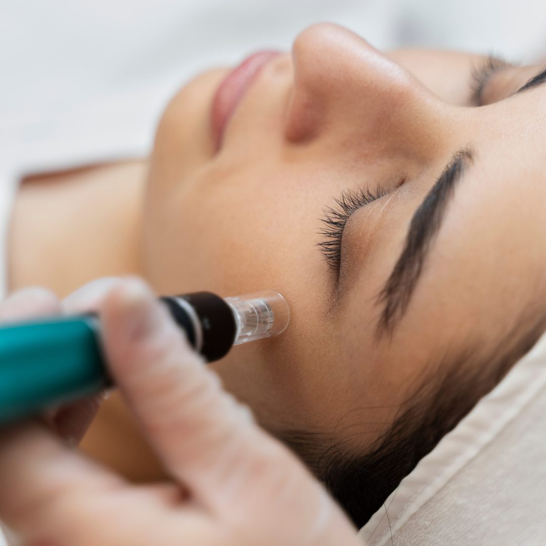 Mezoterapia mikroigłowa